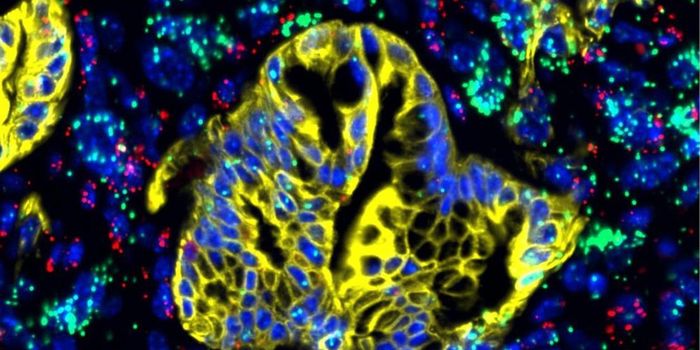 A Better Way Diagnose Pancreatic Cancer for Improved Outcomes