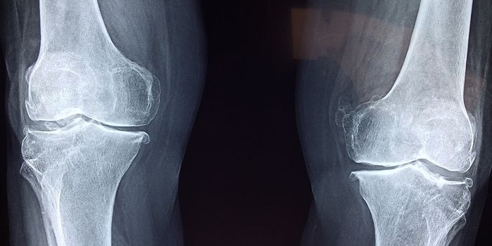 Can a Low-Carb Diet Treat Osteoarthritis?