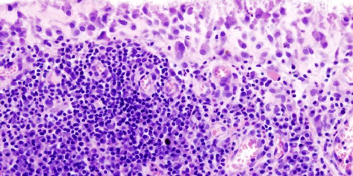 Targeting the Root Cause of Rheumatoid Arthritis