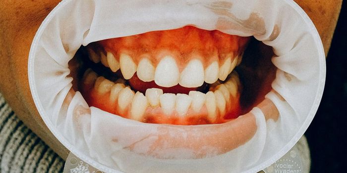 Type 2 Diabetes Treatment Reduces Gum Disease Inflammation
