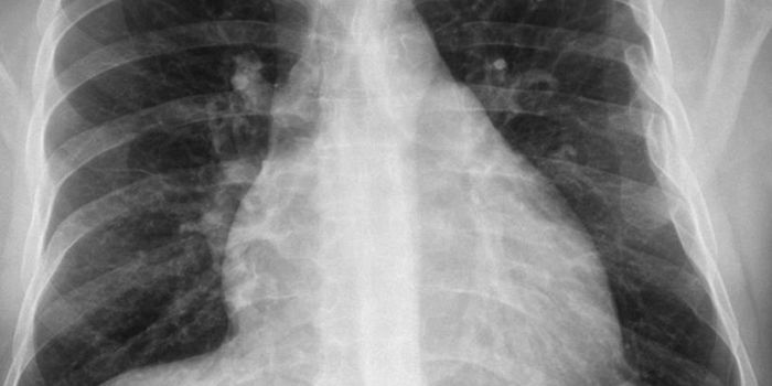 How bad is YOUR pulmonary arterial hypertension?