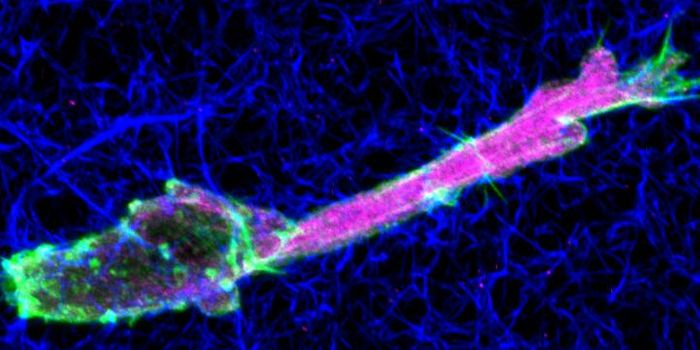 Tumor Cells Move Through Tissue in a Unique Way