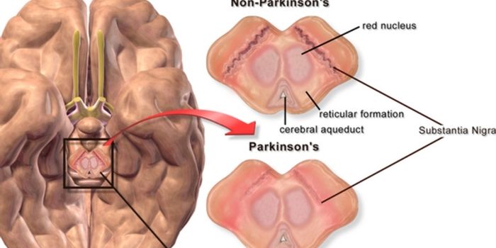 Wearable Tech for Parkinson's Tremor