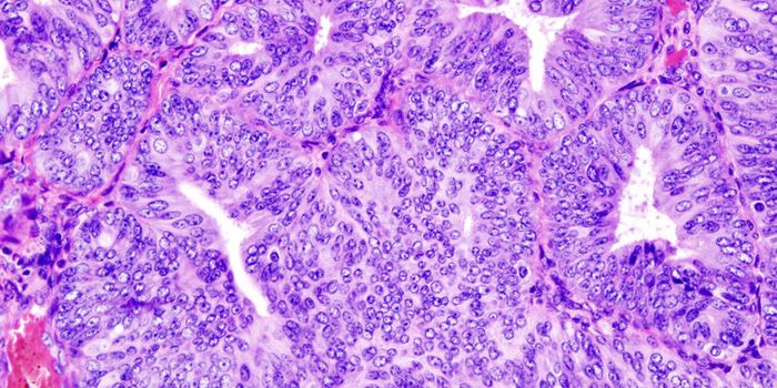 Detecting Endometrial Cancer Earlier with Genomics