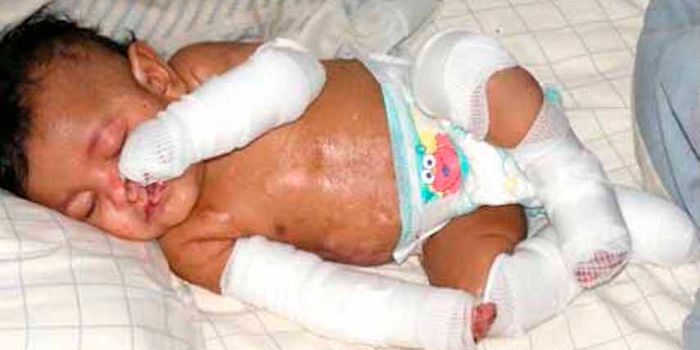 Gene Therapy Saves a Butterfly Child