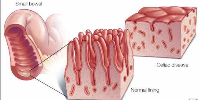 Antibody Offers New Hope For Celiac Disease Patients