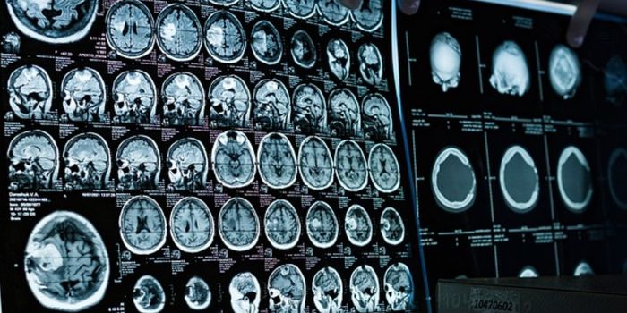 Microstructural Changes in the Brain Could be Used to Diagnose Autism