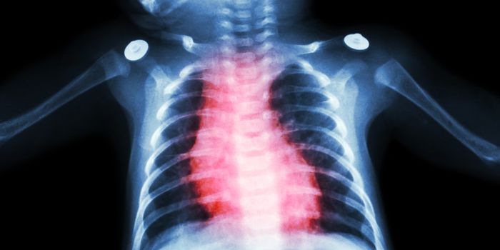 Single-Ventricle Defects Definitively Linked to Brain Abnormalities