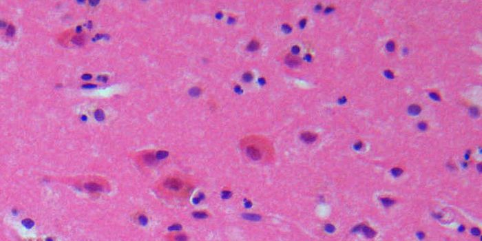 Risk Factors for Stroke That Only Women Have