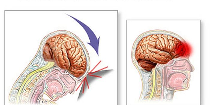 Report Says NFL Tried to Meddle in Concussion Research