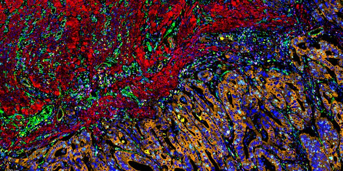 Exploration of tumor-immune landscape in colorectal adenocarcinoma using AI-powered multiplexed image analysis