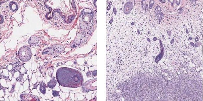 Two Genes Linked to Deadly Form of Bacterial Infection