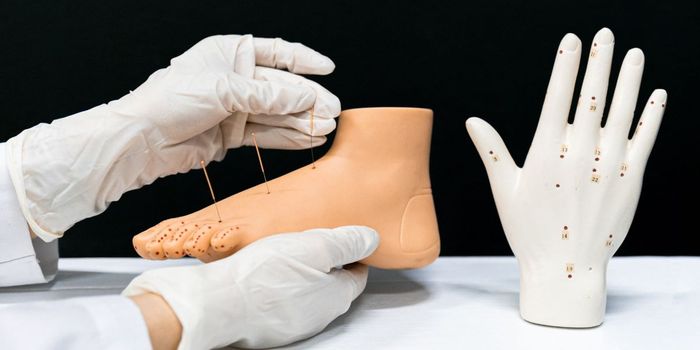 Acupuncture Alleviates Chronic Tension Headaches in Randomized Controlled Trial