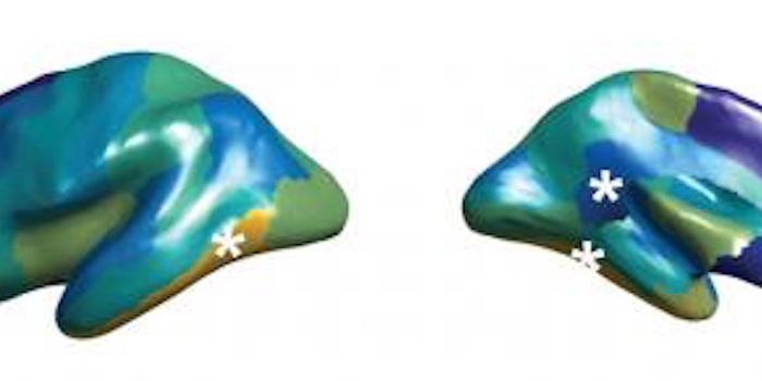 Brains are More Symmetrical in People With Autism