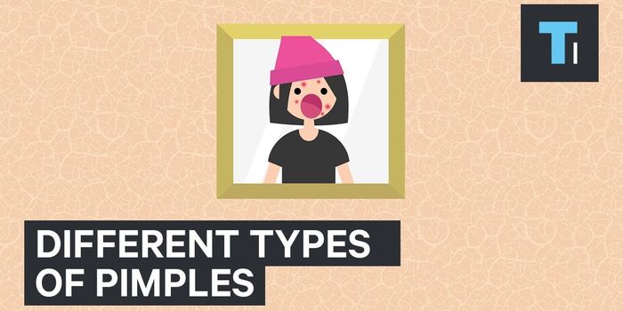 The Various Kinds of Pimples and How They're Treated