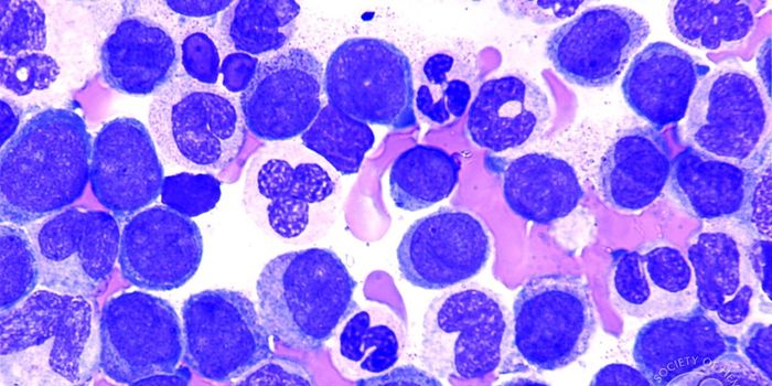 Mutation in Cancer Gene Predicts Treatment Response in Leukemia
