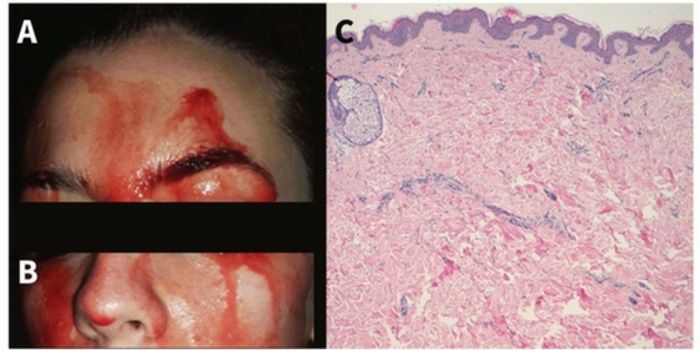 Diagnosed: Rare Condition Causes Woman to Sweat Blood