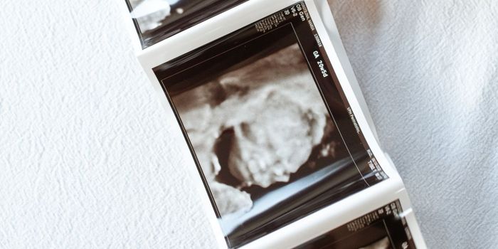 Prenatal Ultrasound Detects Early Signs of Autism