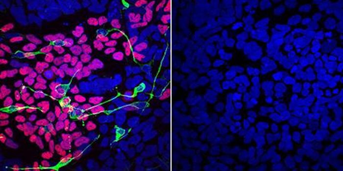 Rare Neurodevelopment Disorder LINKED is IDed