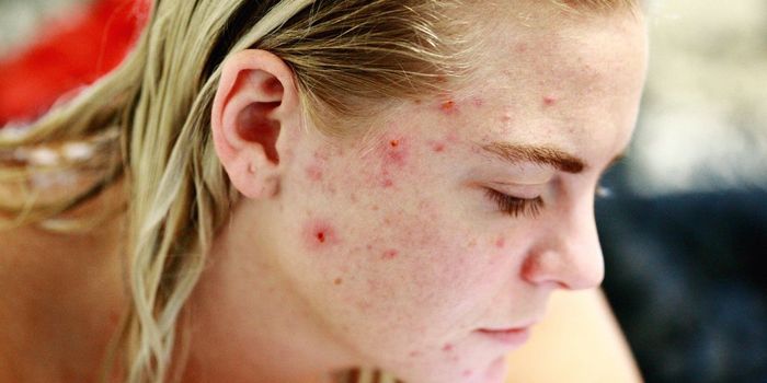 CBD Oil May Treat and Prevent Acne