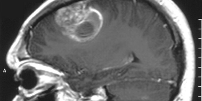 Clinical Trial of Combination Therapy Extended Life After Glioblastoma