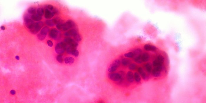 Another Step Forward in the Fight Against Breast Cancer