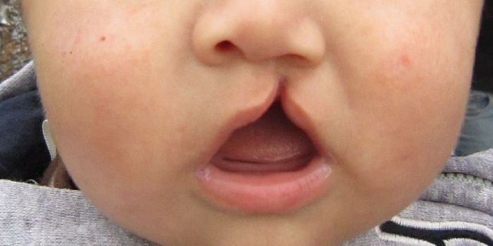 Treatment Could Reverse Cleft Palate in the Womb