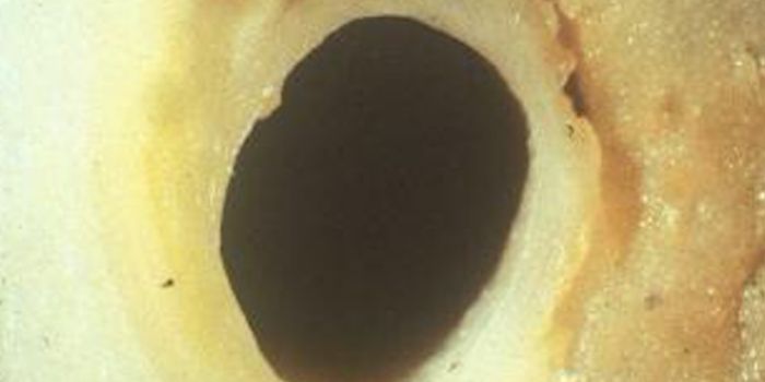 Reducing Cholesterol with Gene Editing