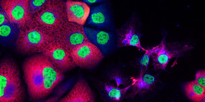 Circulating Tumor Cells Signal Prostate Cancer Invasion