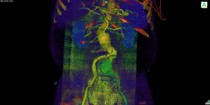 When do you really need to be screened for aortic aneurysms?