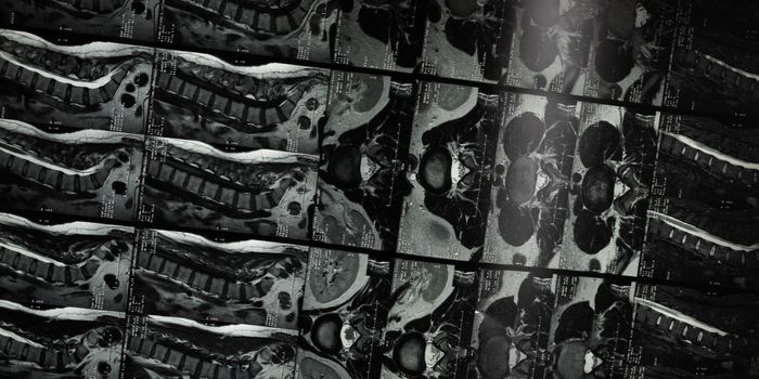 Experimental Cancer Drug Regrows Nerves in Spinal Cord Injury