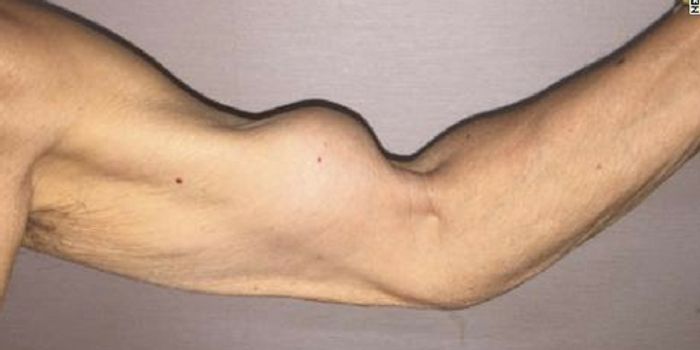 Diagnosed: What Really Caused this Man's Popeye Biceps?