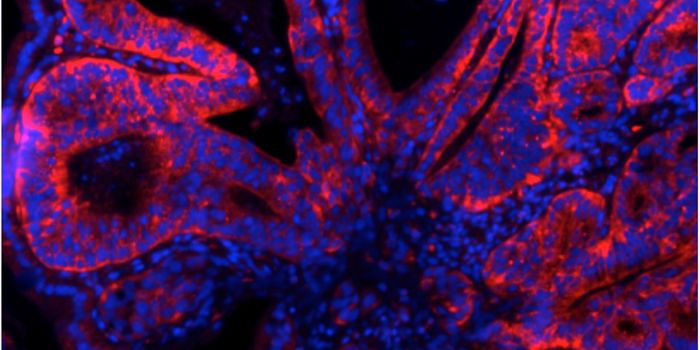 Protein Could Account for Rise in Colon Cancer