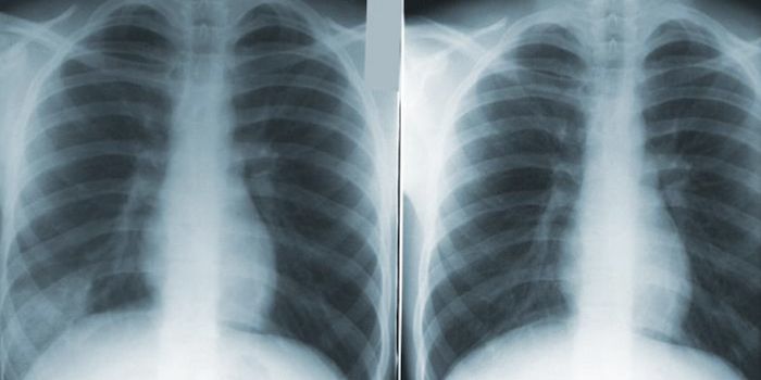 COPD May be Caused by Aberrant Stem Cells