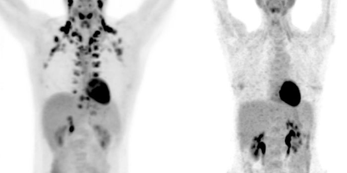 Brown Fat Appears to Protect Against Disease