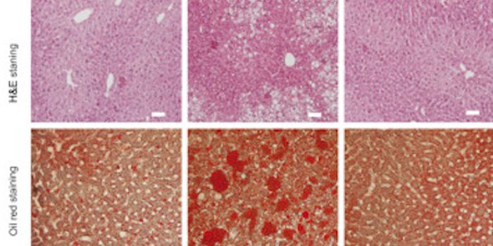 Study Confirms Gastric Bypass Surgery Reverses Type 2 Diabetes Symptoms