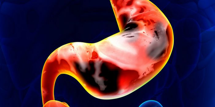 Gastric Cancer Screening Tool Using Serum Biomarkers Being Studied in South Korea