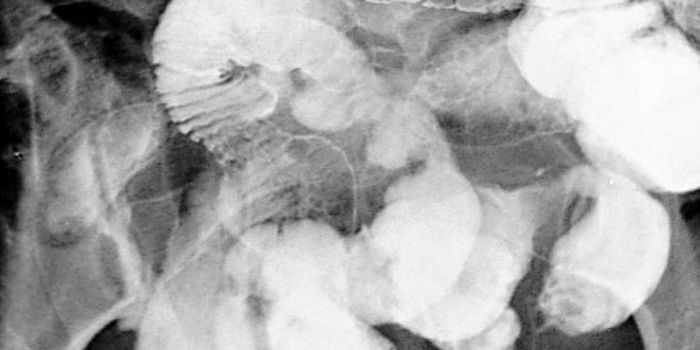 Interaction Between T Cells and Bile Tells the Story of Crohn's Disease