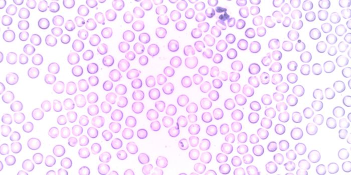 Protein Inhibition Found to Sensitize Aggressive Lymphoma to Therapy