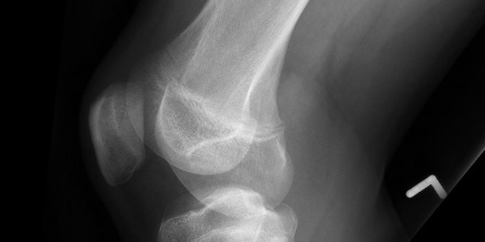 Single Radiation Dose Now Shown to Treat Bone Cancer Pain