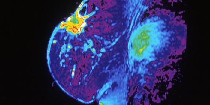 Genetic Screening Could Improve Breast Cancer Prevention