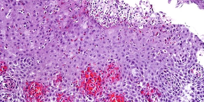 An Emerging Chronic Food Allergy: Eosinophilic Esophagitis