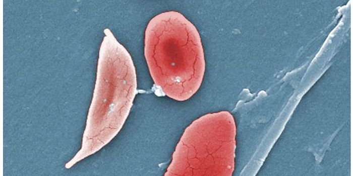Sickle Cell Drug Offers "Overwhelming" Gains as "Exciting" Stem Cell Trial Starts