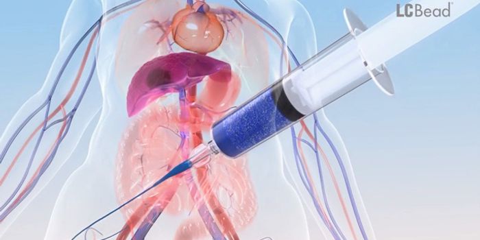 Luminescent, Chemo-Filled Beads to Shrink Liver Cancer