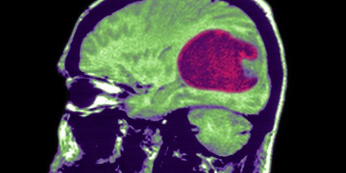 Gene Therapy for Glioblastoma