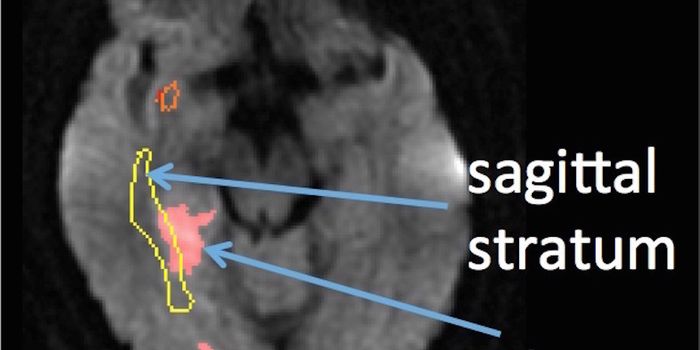 Oh, Joy: Brain's Sarcasm Center Found