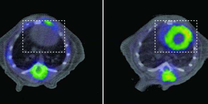 Heart Failure Caused By Mitochondrial Defect