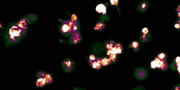 Flesh-Eating Bacteria in Patients with Rheumatoid Arthritis