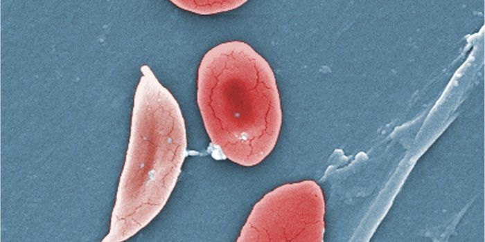 Promising Results From Early Trials of Gene Therapy for Sickle Cell Anemia