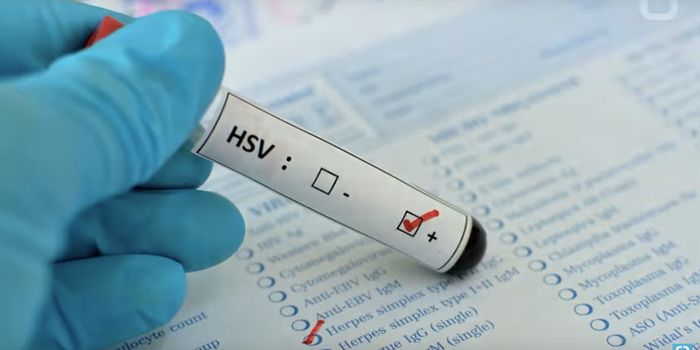 3D Cell Culture Model Suggests Herpes Can Cause Alzheimer's